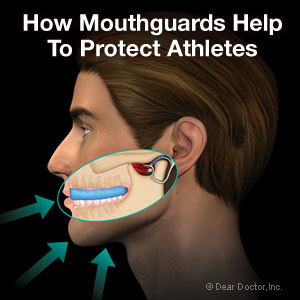 athletic-mouthguards-thumb