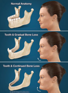 consequences-of-tooth-loss-thumb