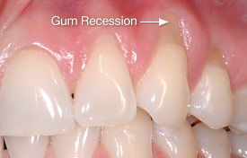 gum-recession