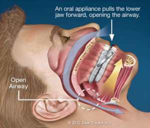 oral-appliance-mouthguard