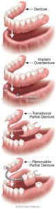 removable-denture-types