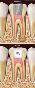 root-canal-retreatment