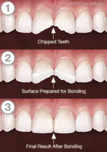 tooth-bonding-series