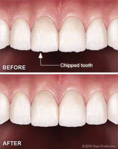 tooth-contouring-reshaping