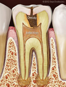 tooth-infection