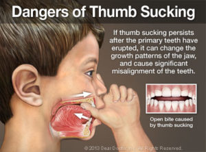 dangers-of-thumb-sucking-thumb