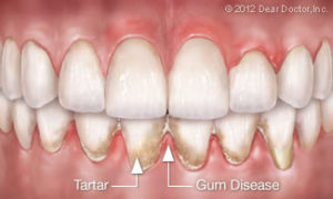 periodontal-gum-disease